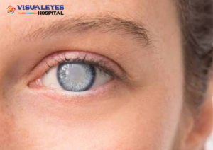 cataract surgery cost