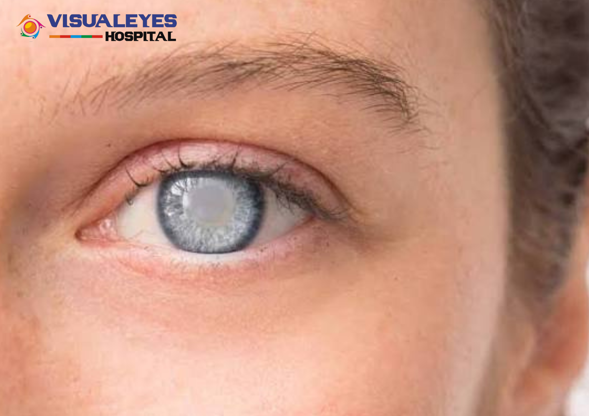 cataract surgery cost