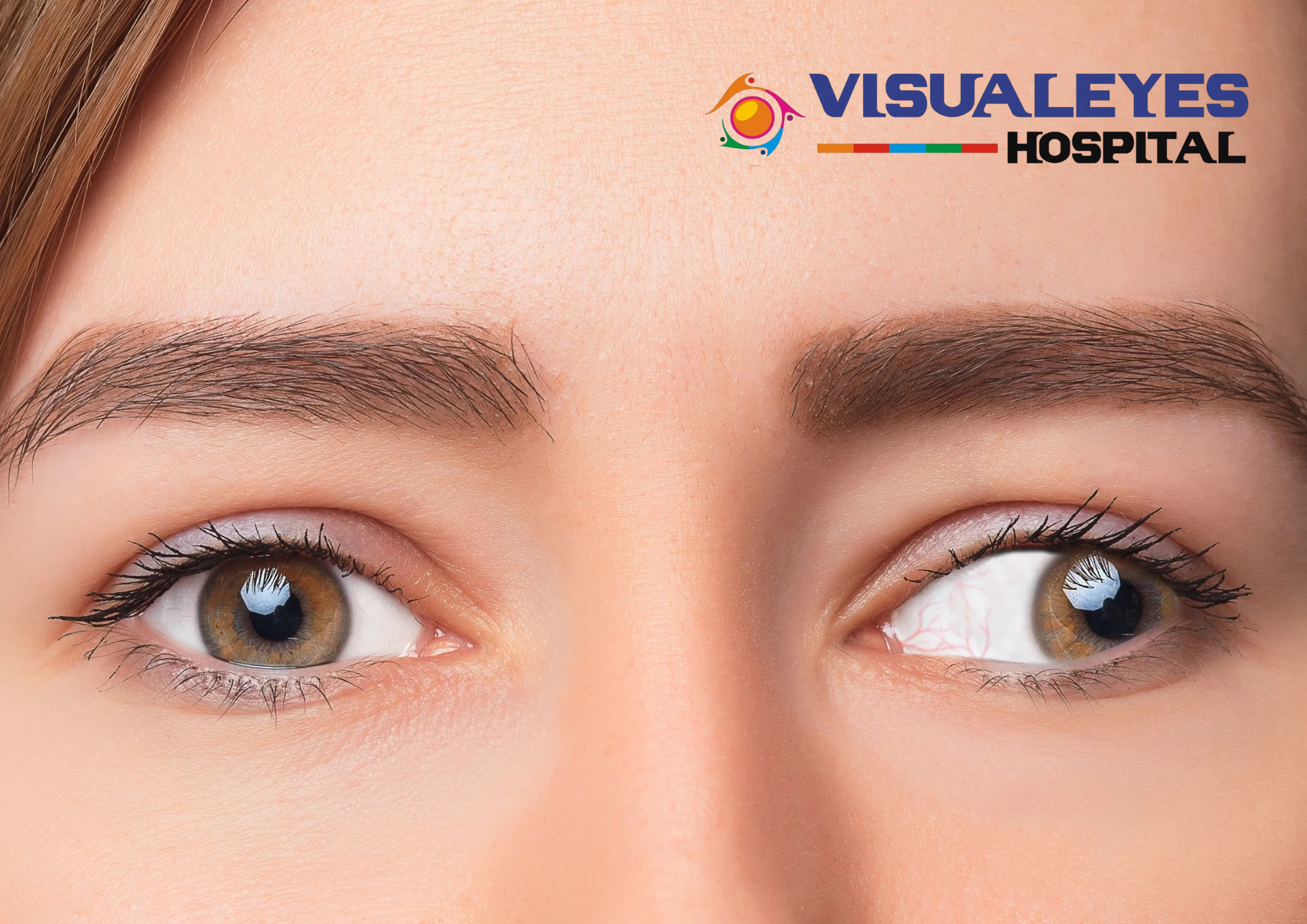 squint eye surgery